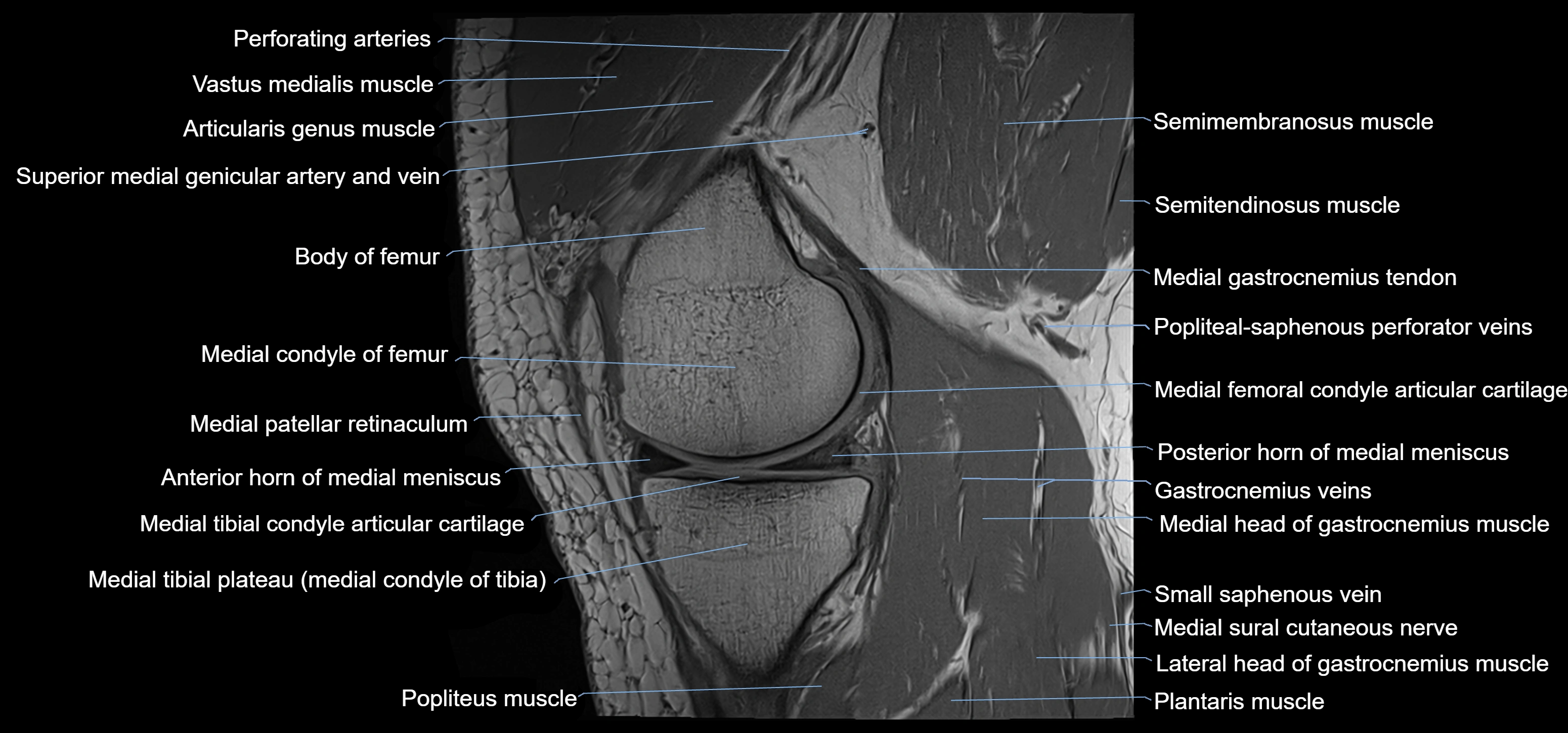 MRI knee sagittal cross sectional anatomy labelled 3T radiology image-00016.webp